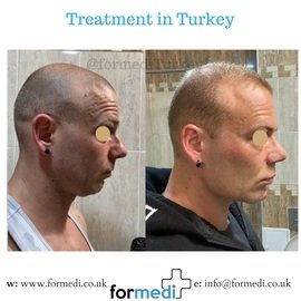Rhinoplasty Turkey
