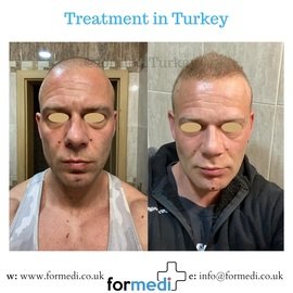 Rhinoplasty Turkey