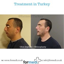 Rhinoplasty Turkey