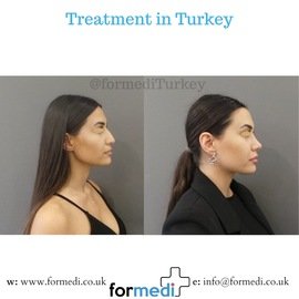 Rhinoplasty Turkey