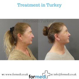 Rhinoplasty Turkey