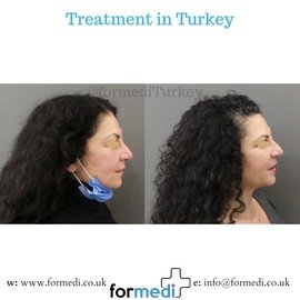 Rhinoplasty Turkey