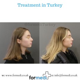 Rhinoplasty Turkey