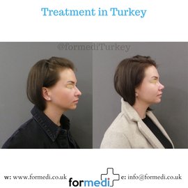 Rhinoplasty Turkey