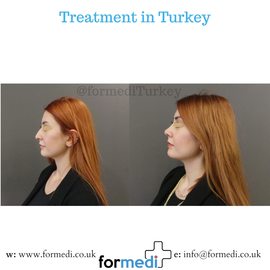 Rhinoplasty Turkey