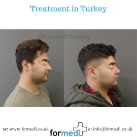 Rhinoplasty Turkey