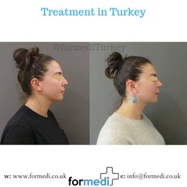 Rhinoplasty Turkey