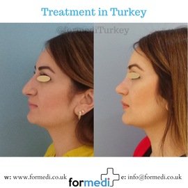 Rhinoplasty Turkey