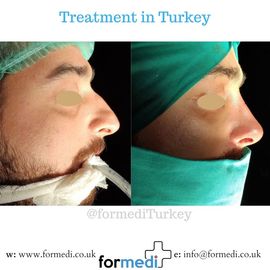 Rhinoplasty Turkey