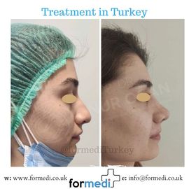 Rhinoplasty Turkey