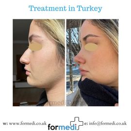 Rhinoplasty Turkey
