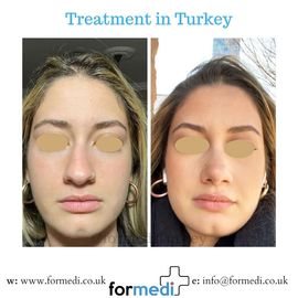 Rhinoplasty Turkey