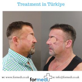 Rhinoplasty Turkey