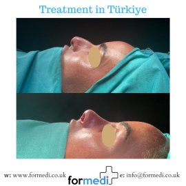 Rhinoplasty Turkey