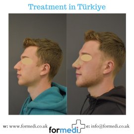 Rhinoplasty Turkey