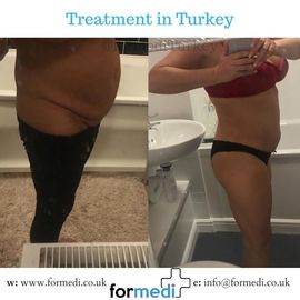 Tummy Tuck formedi Turkey