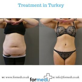 Tummy Tuck formedi Turkey