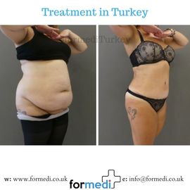 Tummy Tuck formedi Turkey