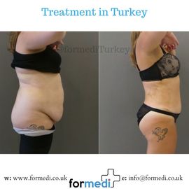 Tummy Tuck formedi Turkey