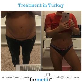 Tummy Tuck formedi Turkey