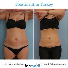Tummy Tuck formedi Turkey