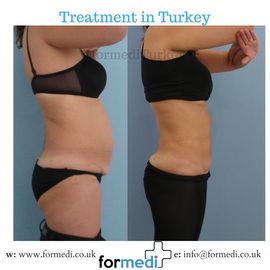Tummy Tuck formedi Turkey