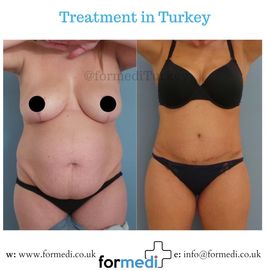 Tummy Tuck formedi Turkey