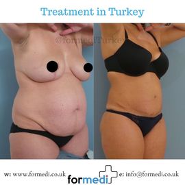Tummy Tuck formedi Turkey