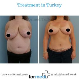 Tummy Tuck formedi Turkey