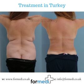Tummy Tuck formedi Turkey