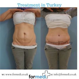 Tummy Tuck formedi Turkey