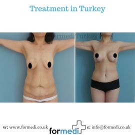 Tummy Tuck formedi Turkey