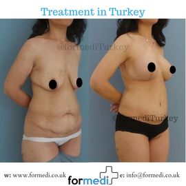 Tummy Tuck formedi Turkey
