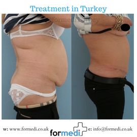 Tummy Tuck formedi Turkey