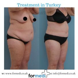 Tummy Tuck formedi Turkey