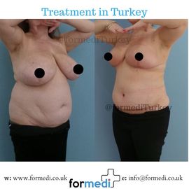 Tummy Tuck formedi Turkey