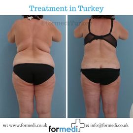 Tummy Tuck formedi Turkey