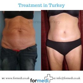 Tummy Tuck formedi Turkey
