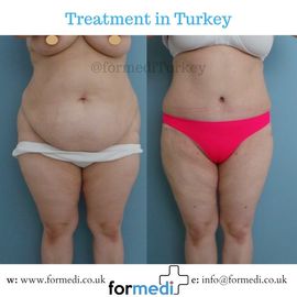 Tummy Tuck formedi Turkey