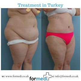 Tummy Tuck formedi Turkey