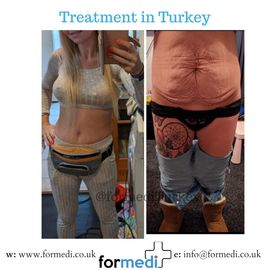 Tummy Tuck formedi Turkey