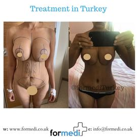 Tummy Tuck formedi Turkey