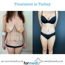 Tummy Tuck formedi Turkey