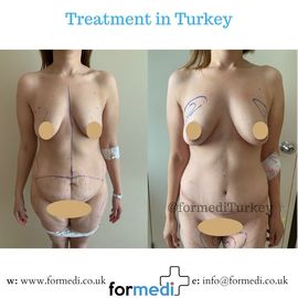 Tummy Tuck formedi Turkey