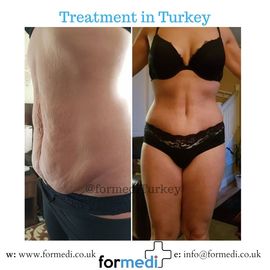 Tummy Tuck formedi Turkey