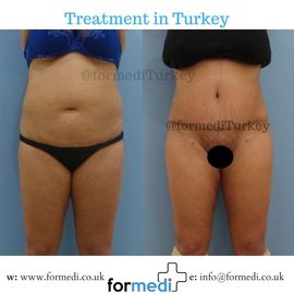 Tummy Tuck formedi Turkey