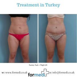 Tummy Tuck formedi Turkey