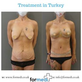 Tummy Tuck formedi Turkey