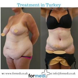 Tummy Tuck formedi Turkey