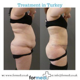 Tummy Tuck formedi Turkey
